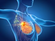Prediction Model for Invasive Breast Cancer Improved With Additional Risk Factors