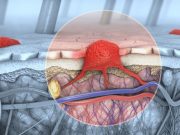 Early FDG PET/CT Can ID Metabolic Changes in Advanced Melanoma