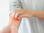 Climatic Hazards Linked to Aggravation of Atopic Dermatitis