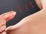 Acupuncture Tied to Improvements in Poststroke Motor Aphasia