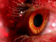 Inherited Genetic Loci Identified for Thinner Retinal Layers Using Optical CT
