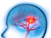 Cerebral Small Vessel Disease Predicts Intracranial Hemorrhage With Antithrombotics