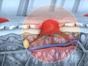 Amtagvi Approved by the FDA for Treatment of Advanced Melanoma