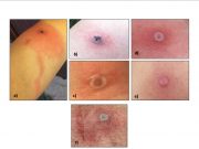 Man Dies in First Fatal Case of Alaskapox