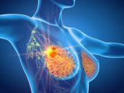 Low-Dose Positron Emission Mammography Helps ID Breast Cancer