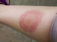 Sharp Increase Seen in Lyme Disease Cases in 2022 After Revised Definition