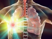 Tislelizumab Plus Chemotherapy Beneficial for Resectable NSCLC