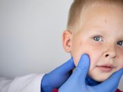 Florida Surgeon General Defies CDC Guidance Amid School Measles Outbreak