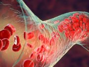 Rate of Venous Thromboembolism Increased With Cancer Surgery