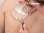 Delayed Melanoma Care During Pandemic Proved Costly