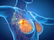 Enobosarm Has Antitumor Activity in ER-Positive, HER2-Negative Advanced Breast Cancer