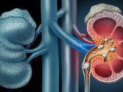 Sodium-Glucose Cotransporter 2 Inhibitors Tied to Lower Kidney Stone Risk