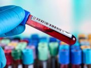 Recommendations Developed for Tests to Support Diagnosis of Syphilis