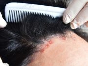 Tacrolimus Microemulsion Has Good Efficacy, Safety for Scalp Psoriasis