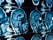 FDA Delays Decision on New Alzheimer’s Drug