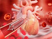 Paclitaxel-Coated Balloon Effective for Coronary In-Stent Restenosis