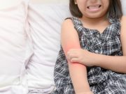 Atopic Dermatitis in Children Tied to Learning, Memory Difficulties