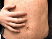 CDC: Number of Reported U.S. Measles Cases Increased in First Quarter of 2024