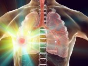 Adjuvant Alectinib Improves Disease-Free Survival in Lung Cancer