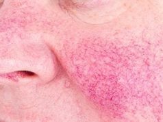 Erenumab Effective, Safe for Rosacea-Linked Erythema, Flushing