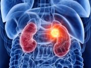 Improvement Seen in Survival With Adjuvant Pembrolizumab in Kidney Cancer