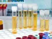 New Prostate Cancer Urine Test Has High Diagnostic Accuracy