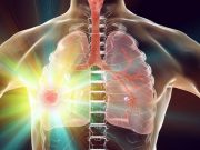 Alecensa Approved as First and Only ALK Inhibitor for Non-Small Cell Lung Cancer