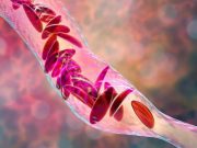 Exa-Cel Eliminates Vaso-Occlusive Crises in Most Sickle Cell Patients