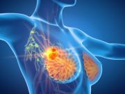 Omission of Completion Axillary-Lymph-Node Dissection Noninferior