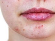 Study Identifies Factors That Affect Antibiotic Prescribing for Acne