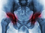 Worse Outcomes Seen for Severe Bilateral Hip OA in Adult Spinal Deformity