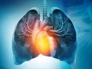 Aficamten Beneficial for Obstructive Hypertrophic Cardiomyopathy