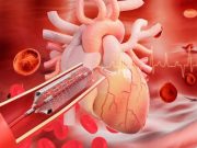 Radial Access for Percutaneous Coronary Intervention Now Dominant Method