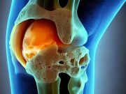 Radiomics Features Can Identify Destabilizing Meniscal Tears