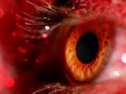 Study Identifies Factors Associated With Hydroxychloroquine Retinopathy