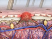 Nonsignificant Survival Benefit Seen for Dabrafenib, Trametinib in Melanoma