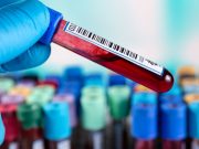 Maternal Serum Alpha-Fetoprotein Levels Higher in Black Than White Women