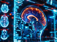 Several Drugs Linked to Risk for Aneurysmal Subarachnoid Hemorrhage