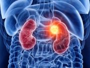 Patients Can Take GLP-1 RA Medications Before Surgery