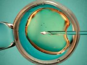 Prehospital Reduction in BP Does Not Improve Stroke Outcomes