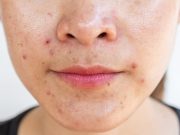 Direct CGRP Inhibition Cuts Acne, Rosacea in Patients With Migraine