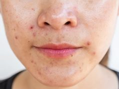 Direct CGRP Inhibition Cuts Acne, Rosacea in Patients With Migraine