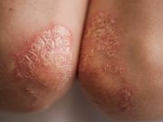 Air Pollution Exposure Tied to New Psoriasis