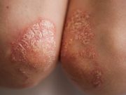 Psoriasis, Psoriatic Arthritis Tied to Higher Risk of Polyneuropathy