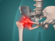 2016 to 2021 Saw Increase in Number of Periprosthetic Fractures