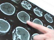 Structure, Function of Brain Connectome Tied to Gray Matter Atrophy in Parkinson Disease