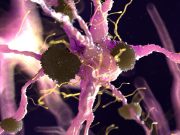 Multiple Sclerosis Linked to Lower Risk for Alzheimer Disease Pathology