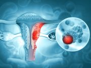 Sacituzumab Govitecan Shows Promise in Advanced Endometrial Cancer