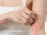 Dietary Vitamin E May Be Protective Against Atopic Dermatitis