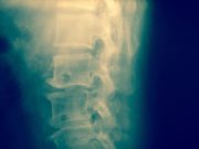 Surgery Effective for Thoracic Ossification of Posterior Longitudinal Ligament